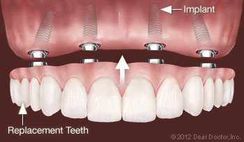 Scaling & Root Planing - Dentist in Hanover PA