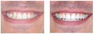 Tooth-Coloured Restoration- Hanover Dentist